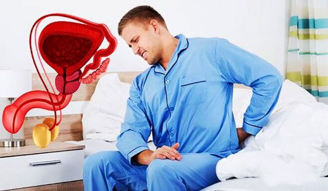 Schmerzen im unteren Rücken aufgrund von Prostatitis