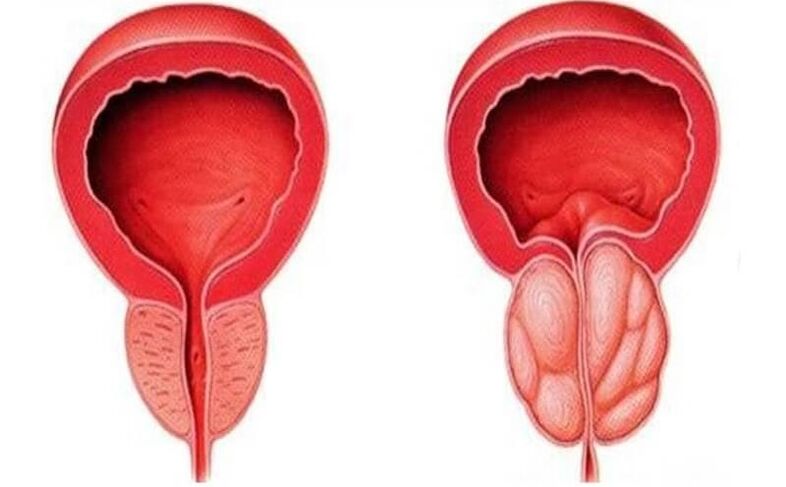 gesunde und entzündete Prostata mit Prostatitis