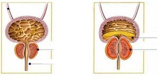 Arten und Formen der Prostatitis bei Männern