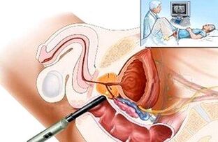 Möglichkeiten zur Diagnose von Prostatitis