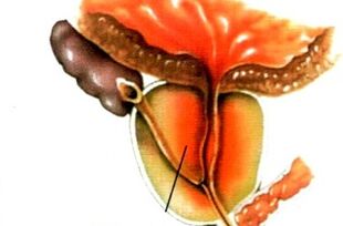 Was ist Prostatitis bei Männern
