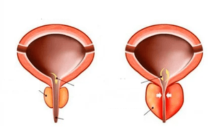 Was ist akute Prostatitis