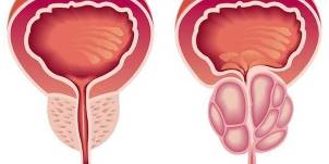 prostatitis