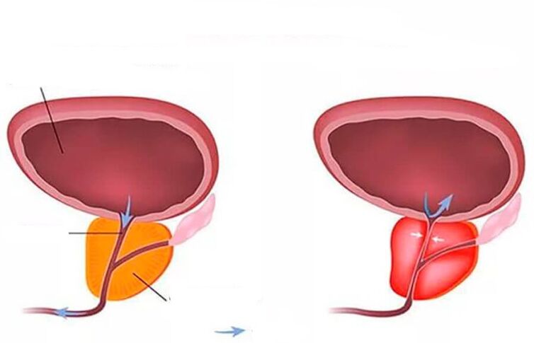 normale und geschwollene Prostata