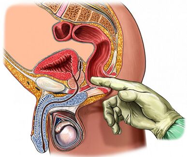 Prostatauntersuchung am Finger