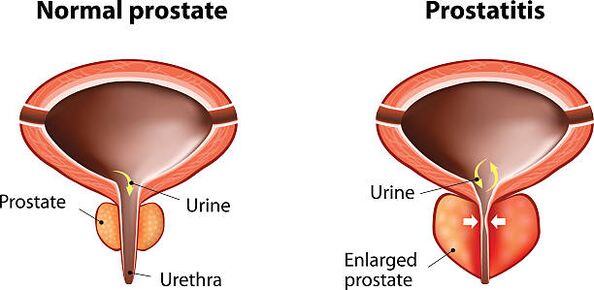 normale und geschwollene Prostata
