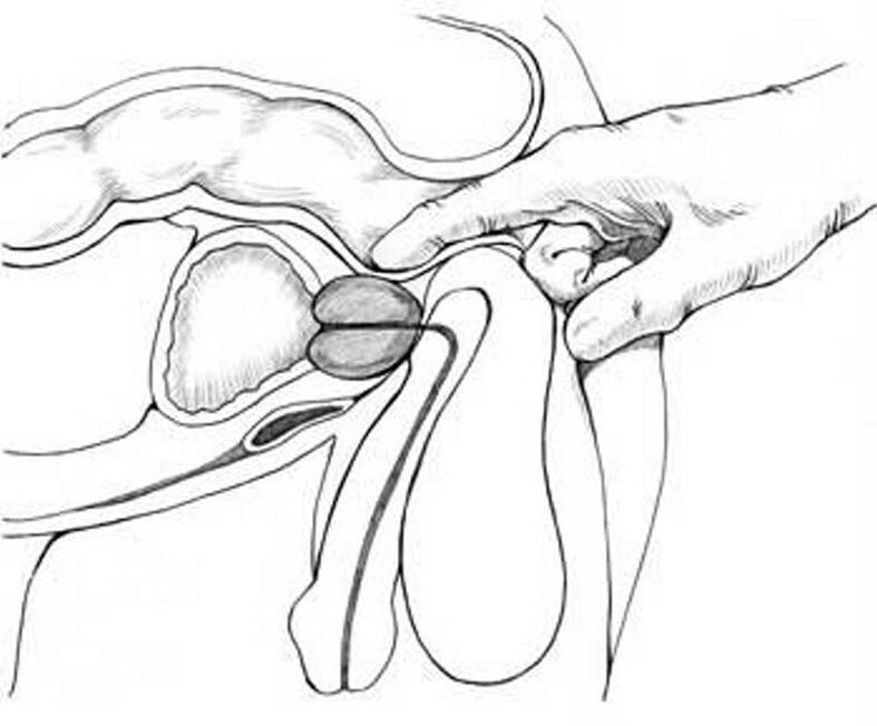 Prostatamassage bei chronischer Prostatitis