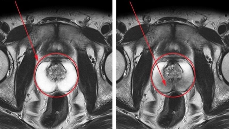 eine gesunde und entzündete Prostata mit chronischer Prostatitis