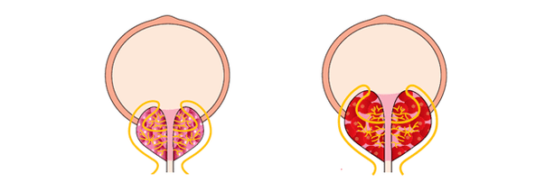 gesunde und entzündete Prostata mit Prostatitis