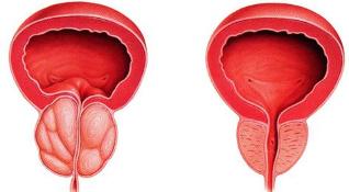 der Unterschied ist der patient und eine gesunde Prostata