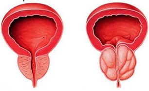 Prostata